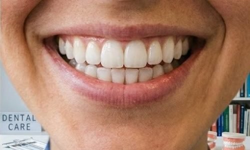 Smile Makeover – 2 bezoeken